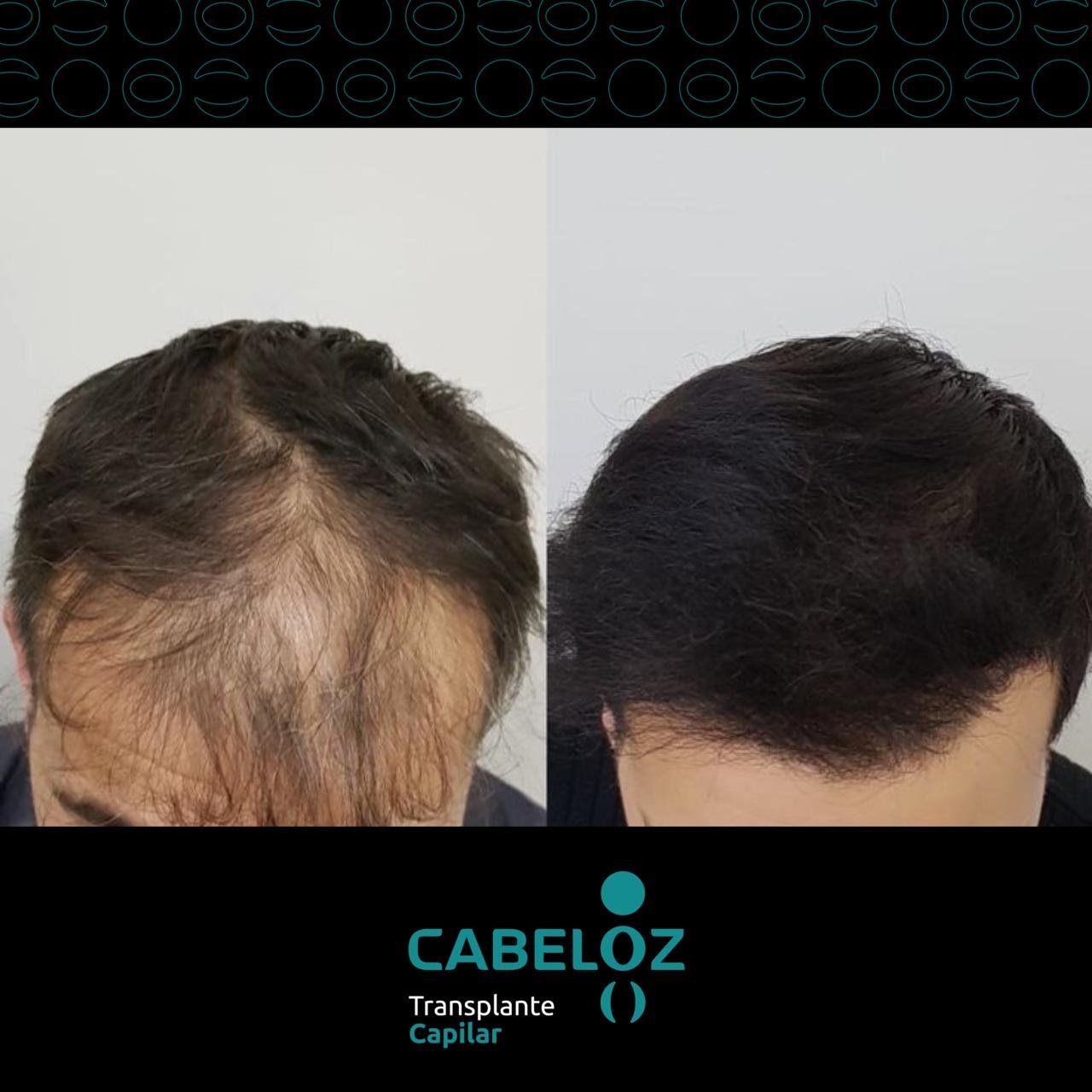 ANTES E DEPOIS - TRANSPLANTE CAPILAR