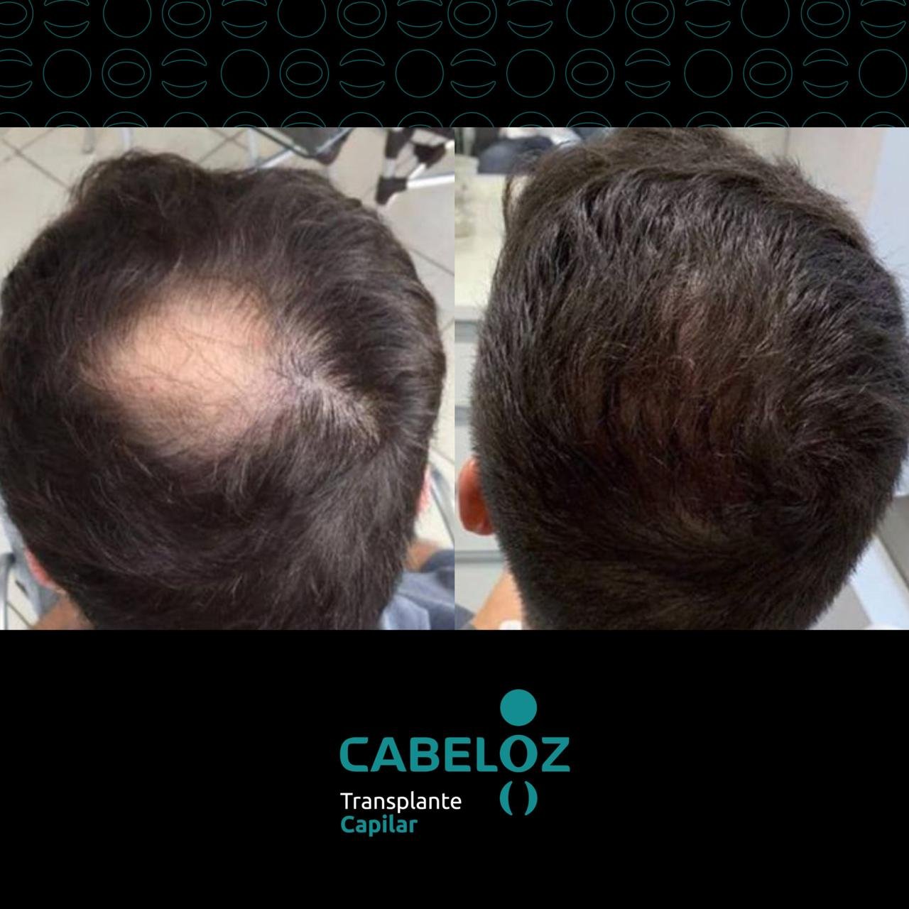 ANTES E DEPOIS - TRANSPLANTE CAPILAR