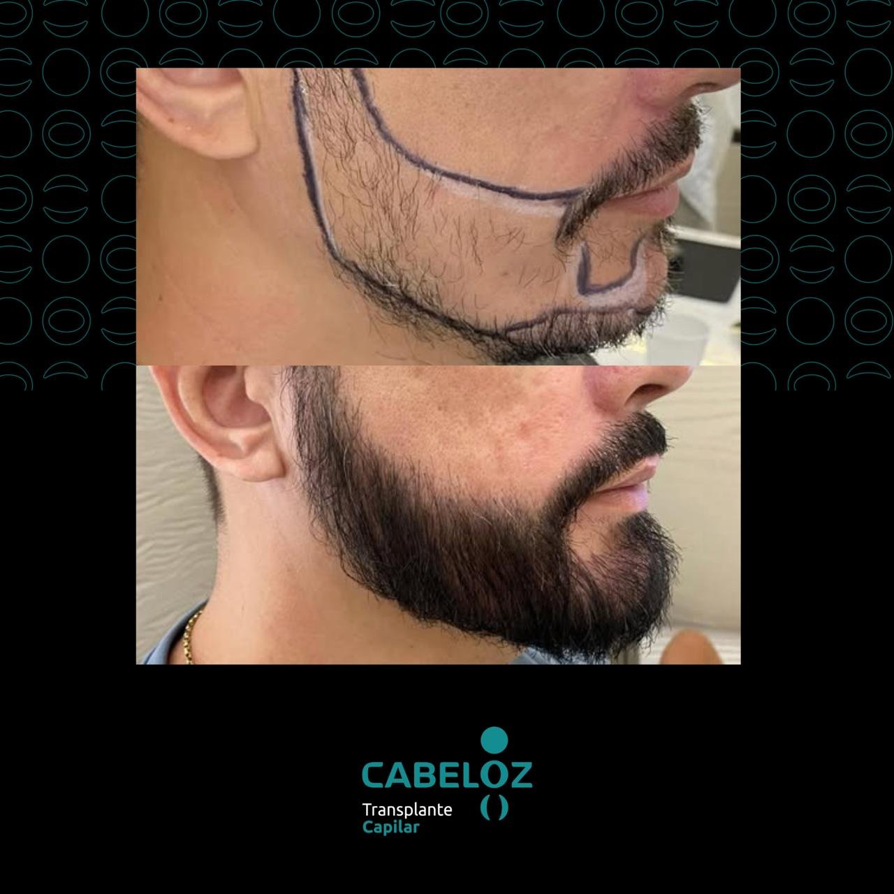 ANTES E DEPOIS - TRANSPLANTE DE BARBA