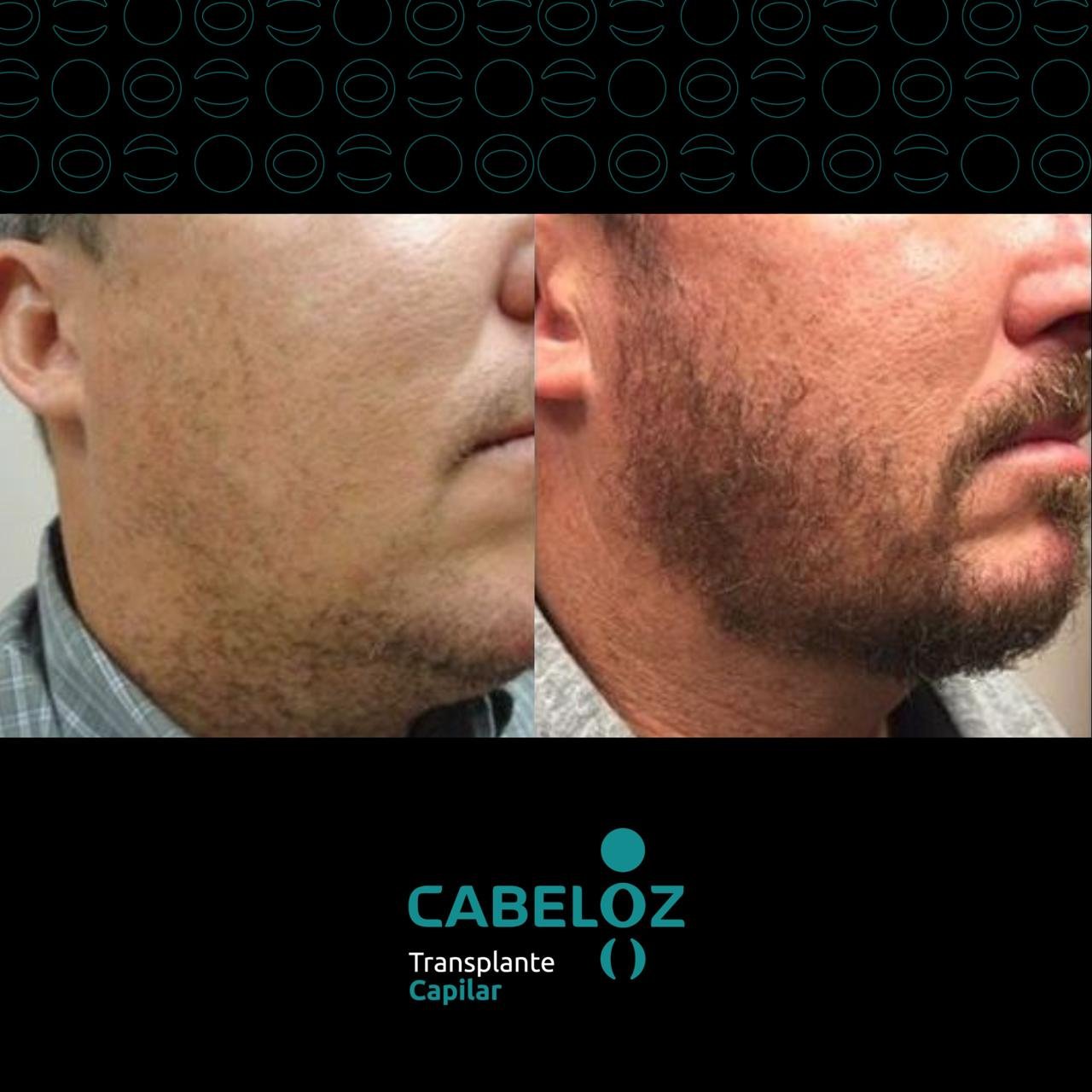 ANTES E DEPOIS - TRANSPLANTE DE BARBA