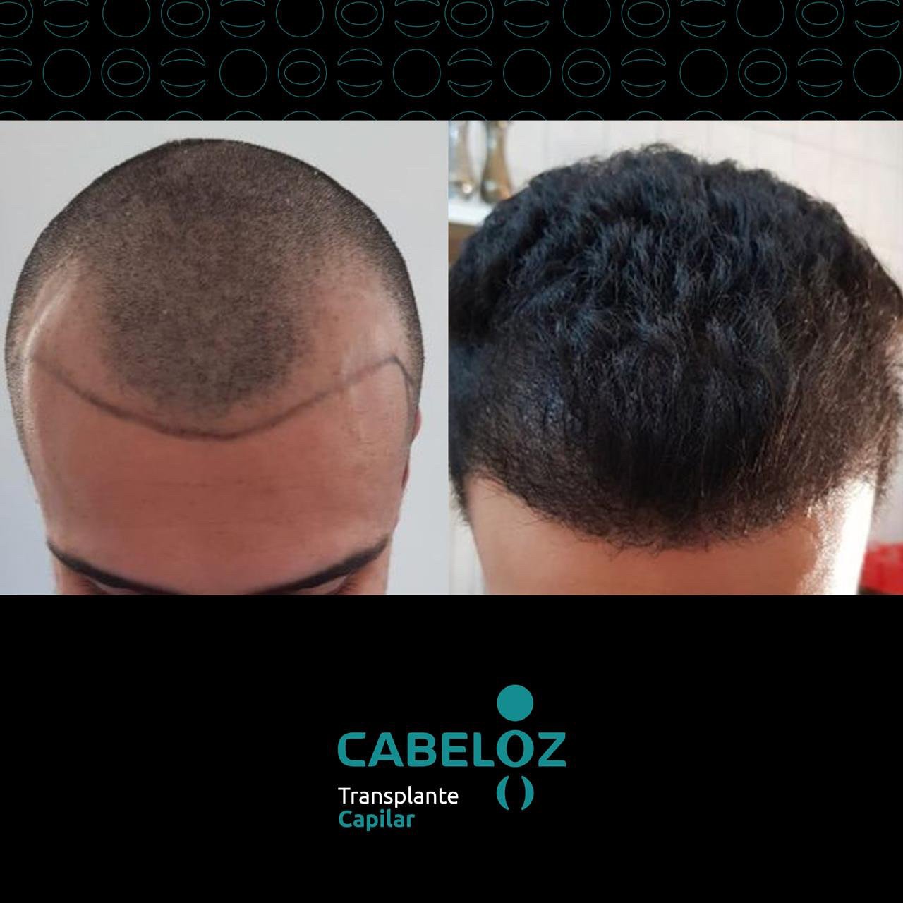 ANTES E DEPOIS - TRANSPLANTE CAPILAR