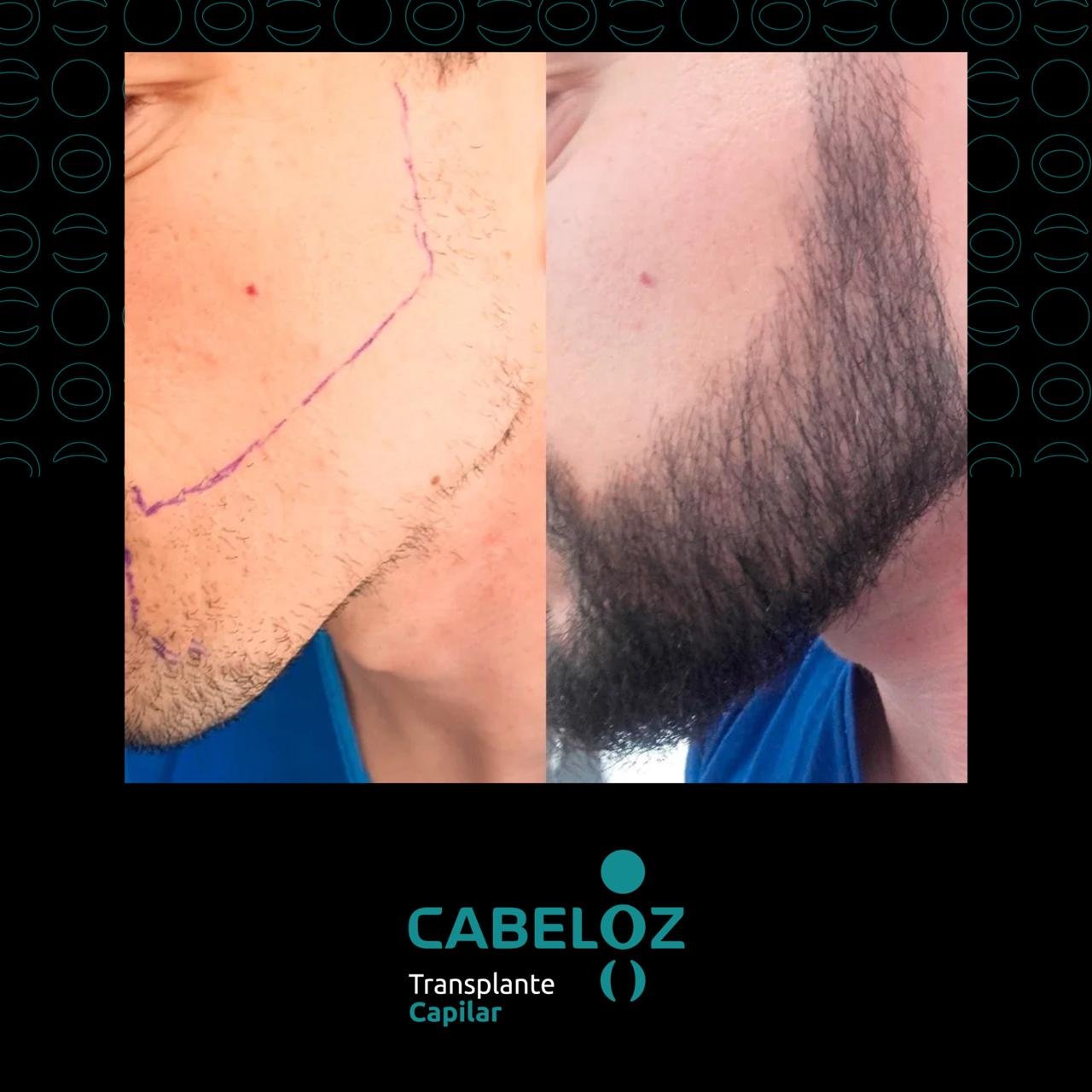 ANTES E DEPOIS - TRANSPLANTE DE BARBA