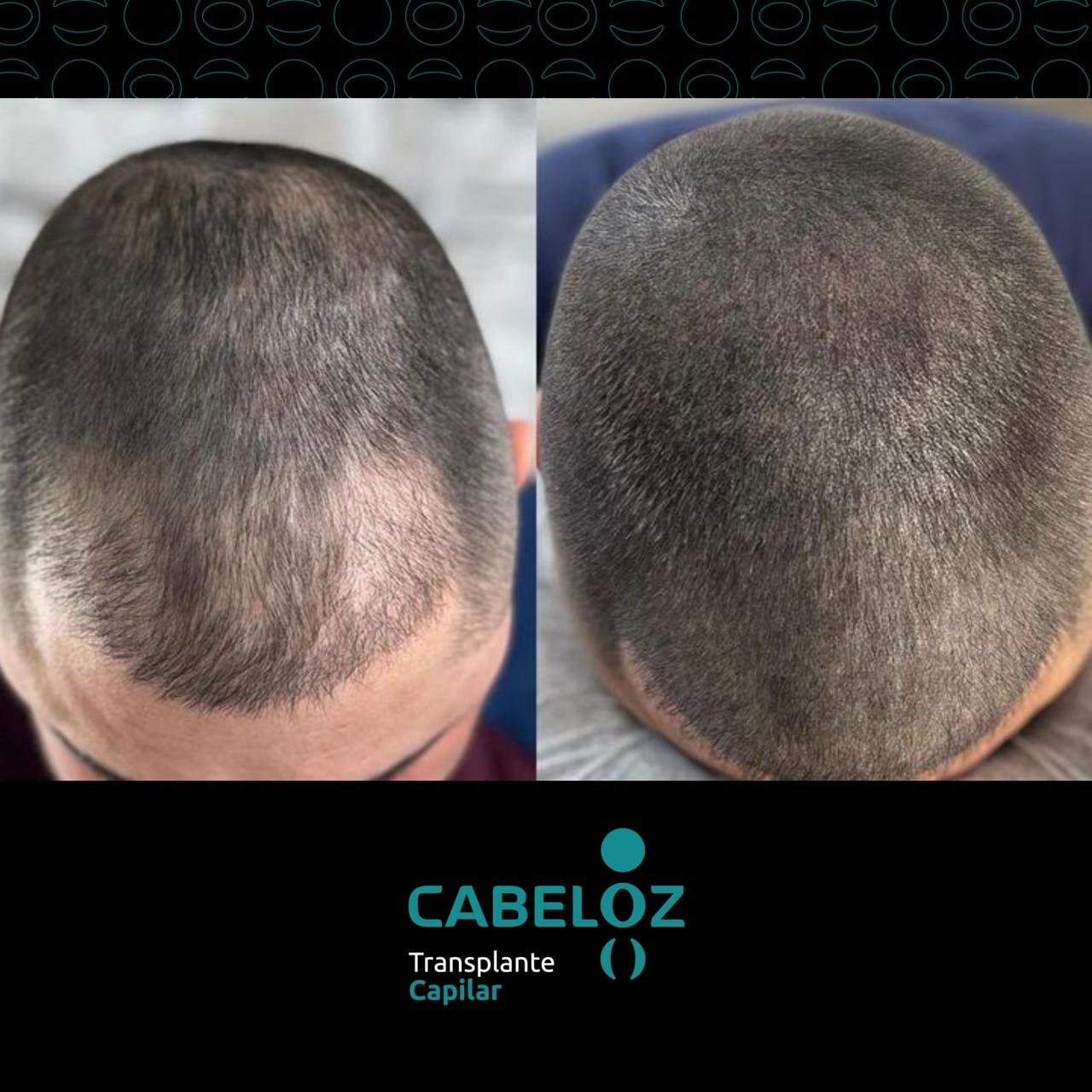 ANTES E DEPOIS - TRANSPLANTE CAPILAR