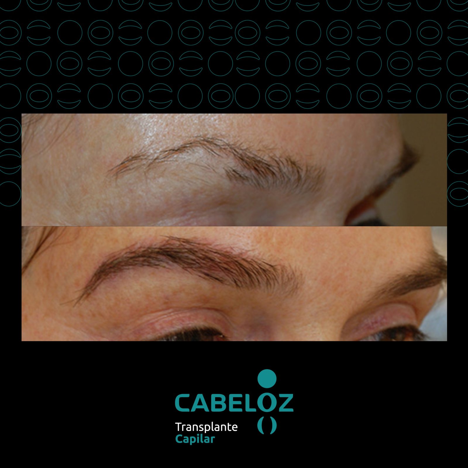 ANTES E DEPOIS - TRANSPLANTE DE SOBRANCELHA