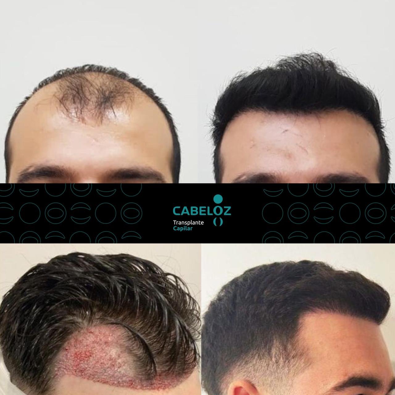 ANTES E DEPOIS - TRANSPLANTE CAPILAR